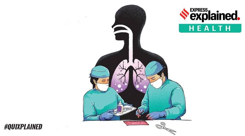 Quixplained: O que é mucormicose ou fungo preto observado em pacientes com Covid-19?