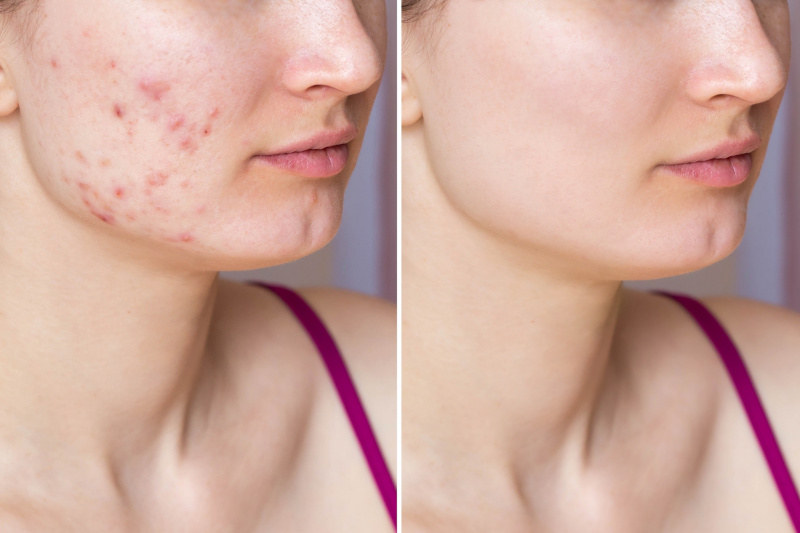 Melhor-Acne-Face-Washes-Stock-Photo