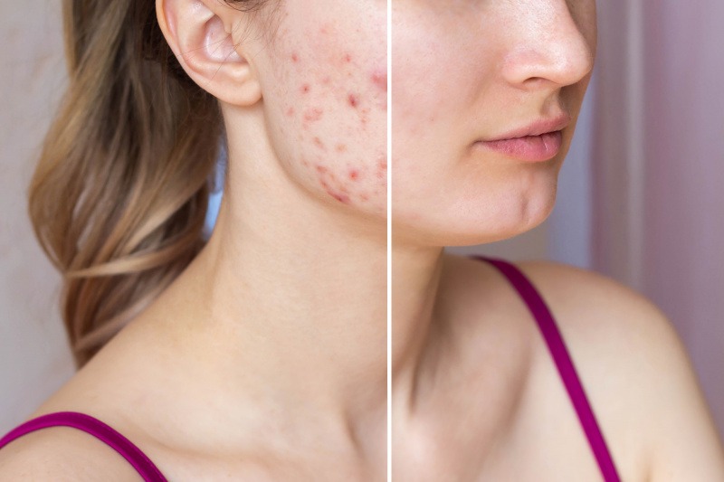 antes-depois-adulto-acne