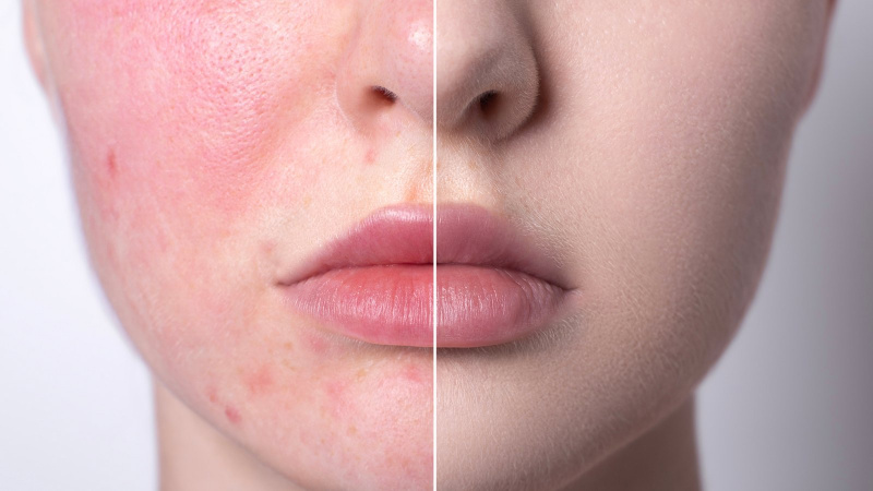 Adeus, Vermelhidão! Encontre alívio real com este óleo facial calmante de $ 18