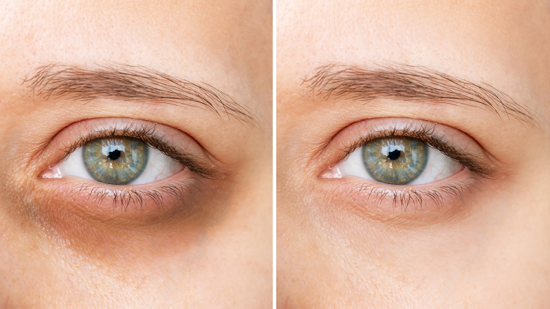   corretivo sob os olhos antes e depois
