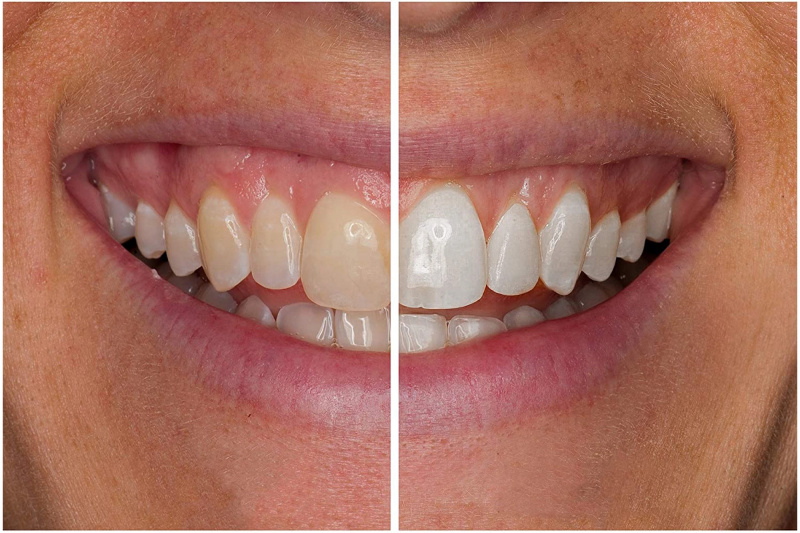   Kit de clareamento dental para neve com luz LED