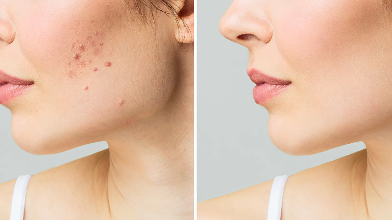   malin-e-goetz-tratamento-acne-durante a noite