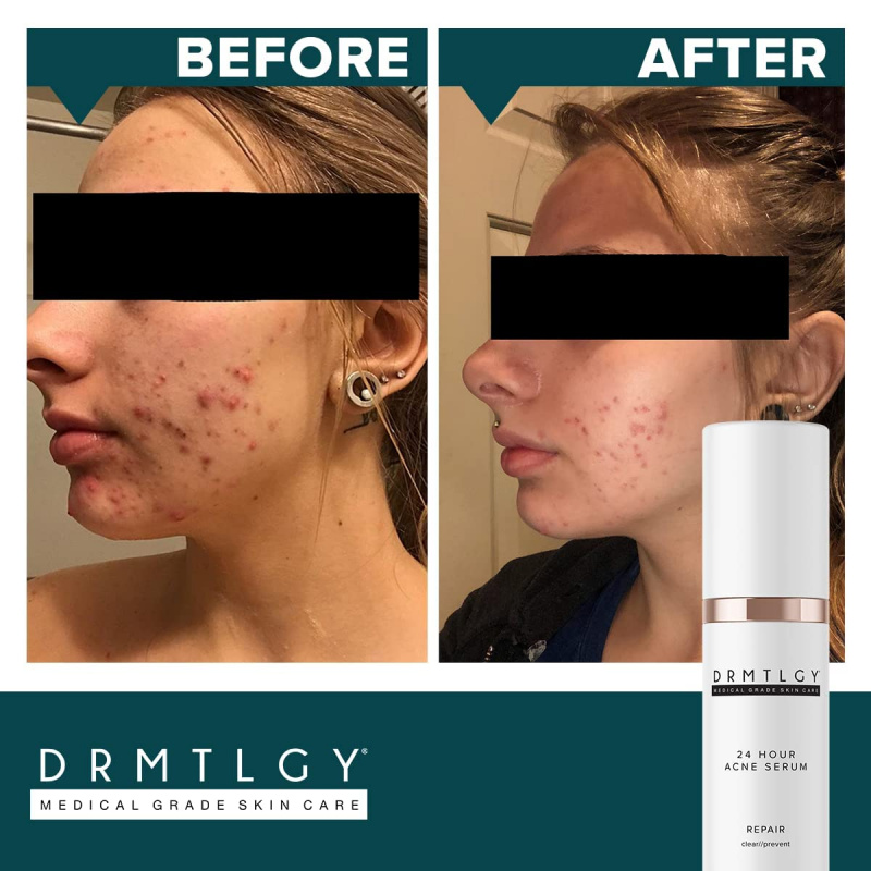   DRMTLGY Acne Spot e Tratamento de Acne Cística