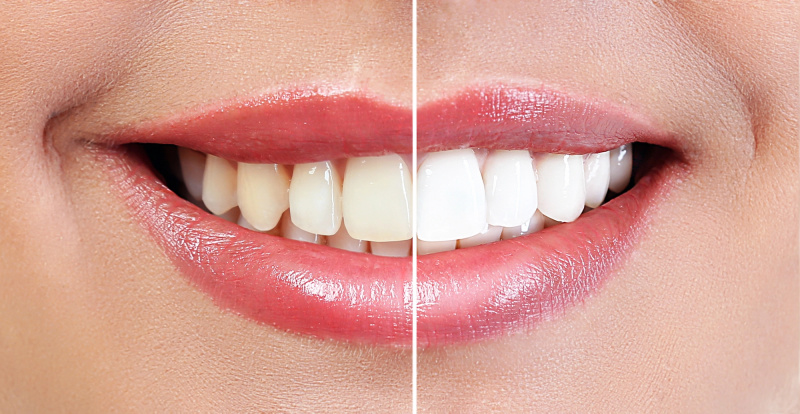 Branco-Dentes-Antes-Depois-Stock-Photo