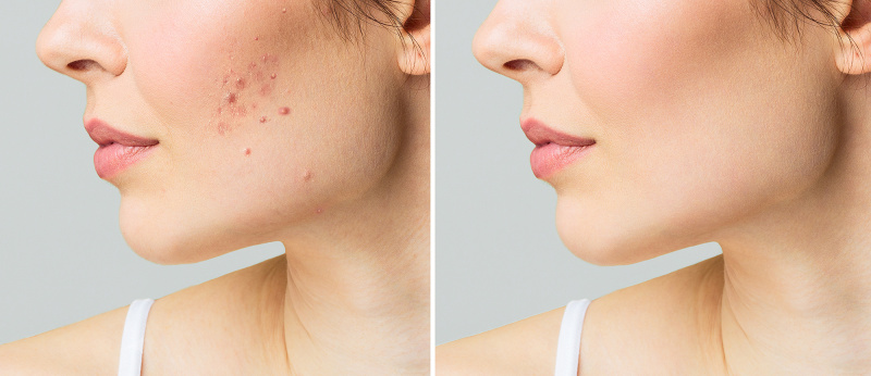 malin-e-goetz-tratamento-acne-durante a noite