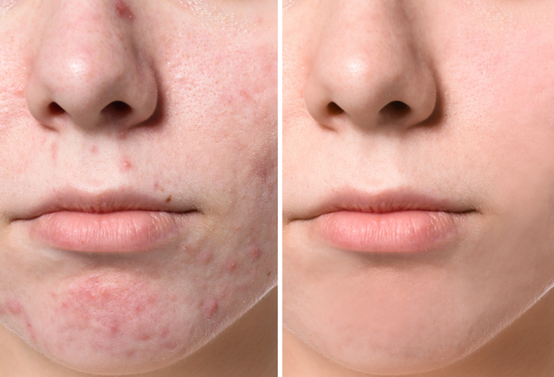   Antes-Depois-Acne-Pele Limpa