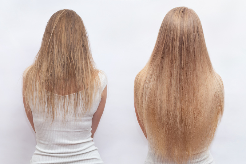 Antes-Depois-Tratamento de Crescimento Capilar