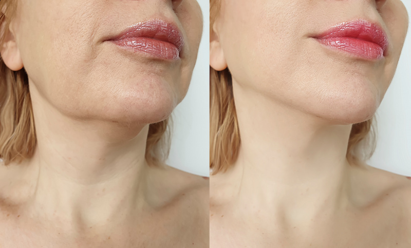   Pescoço-Lift-Antes-e-Depois-Stock-Photo