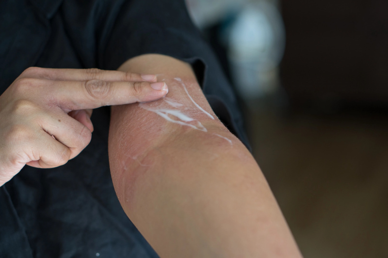   Loções-para-Eczema-Stock-Photo